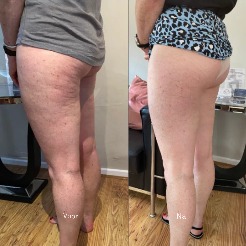 Mira™ | Anti cellulite - Je huid, maar dan strakker