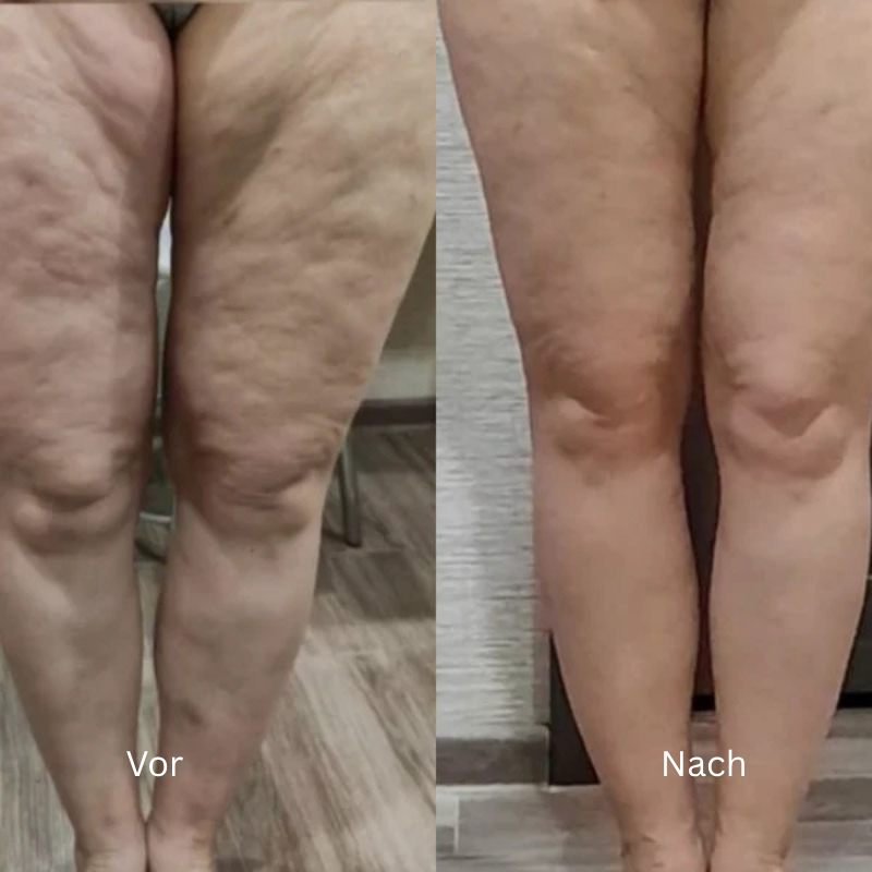 Mira™ – Anti-Cellulite Massagegerät