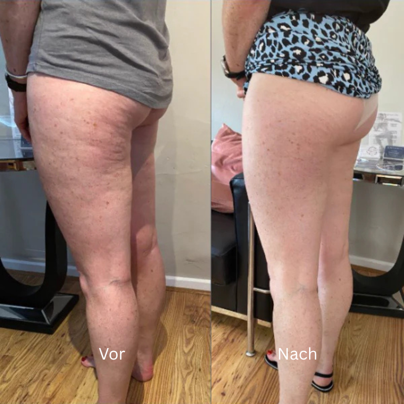 Mira™ – Anti-Cellulite Massagegerät