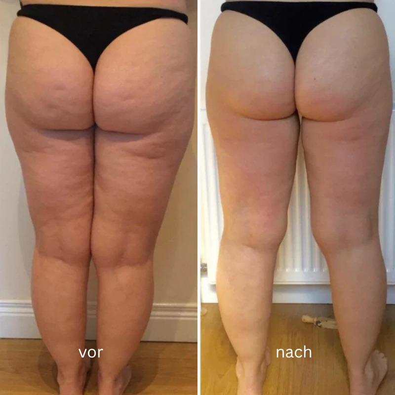 Mira™ – Anti-Cellulite Massagegerät