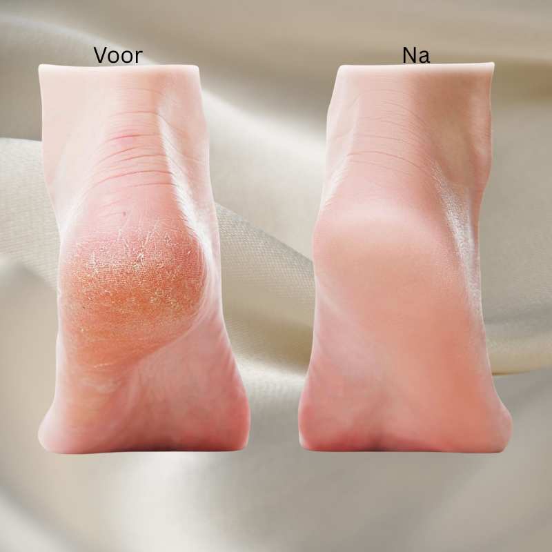 SmoothStep™ |Elektrische Eeltverwijderaar